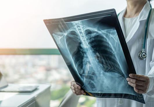 X-ray image of lungs