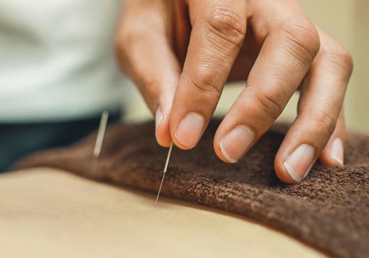acupuncture needles being inserted in patient 