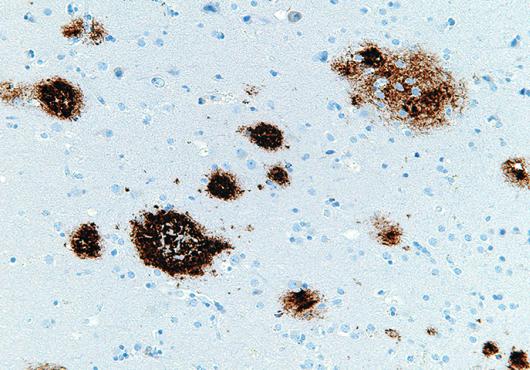 amyloid beta plaques