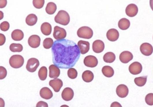 Pink-stained cells on a white background are interrupted by one misshapen purple-stained cell
