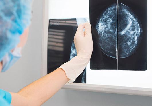 A clinician (a doctor or a nurse) looks at an X-ray scan of breast cancer