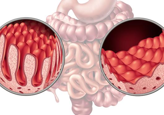 normal and damaged villi from celiac