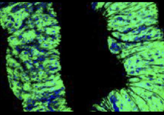 Microscopic image of cancer cells in fly gut