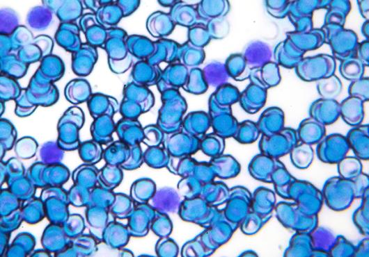 leukemia cells