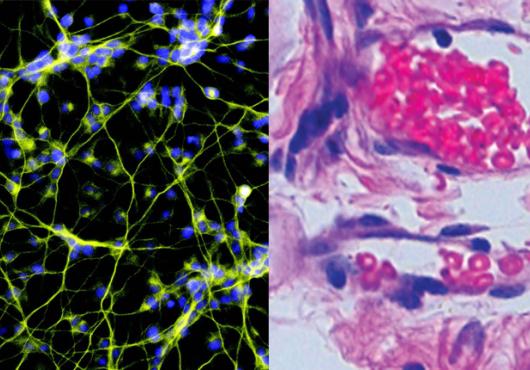 Combined image of two micrographs. On left, web of yellow threads with blue nuclei against a black background. On right, swirls of pink and purple stained cells on a gray background.