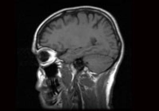 An MRI of a brain