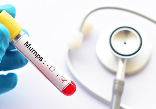 photo of gloved hand holding vile marked mumps