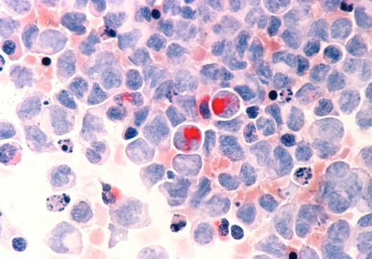 Human cells with acute myelocytic leukemia (AML) in the pericardial fluid, shown with an esterase stain at 400x