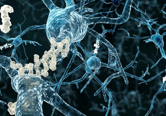 neurons with amyloid plaques