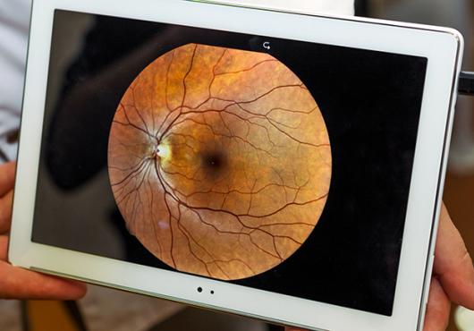 image of ocular funds being presented on an iPad 