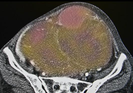 ovarian cancer image
