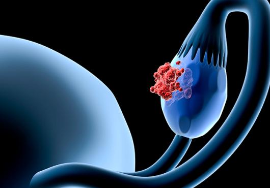 illustration of ovarian cancer