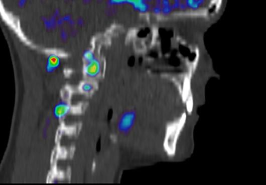 An image of a person’s head and neck showing normal tissue in black and white tones and inflammation in bright colors.