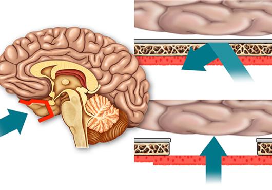 Bypassing the Blood-Brain Barrier
