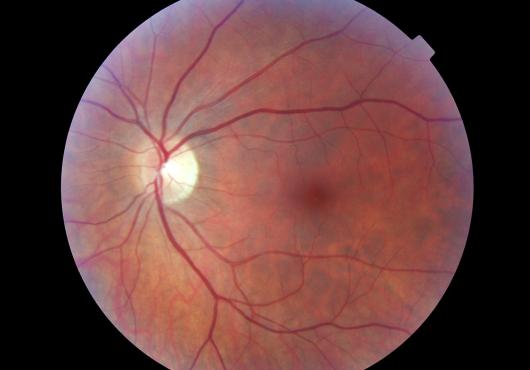 Bicarbonate for Better Vision?