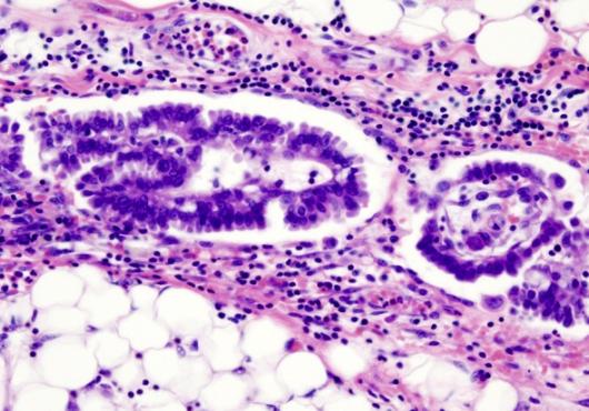 Delivering Hope in Ovarian Cancer