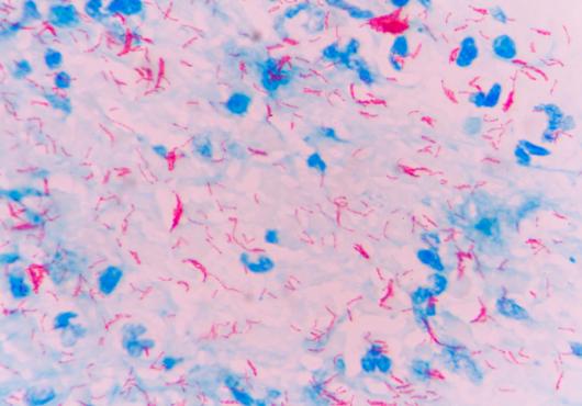 New TB Risk Factor