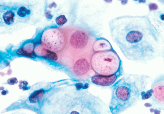 Safeguarding Against Chlamydia