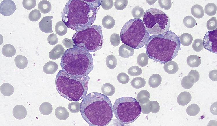 healthy cells shown in gray while cancerous cells are large and stained purple
