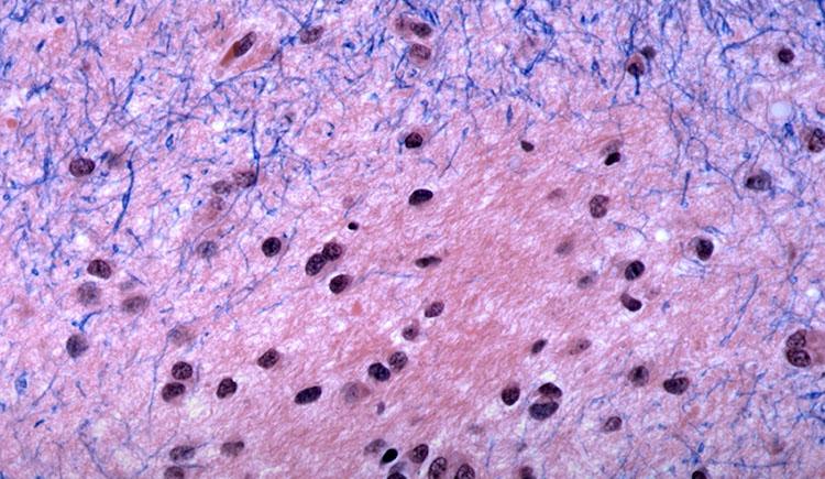 Brain tissue in Huntington’s disease