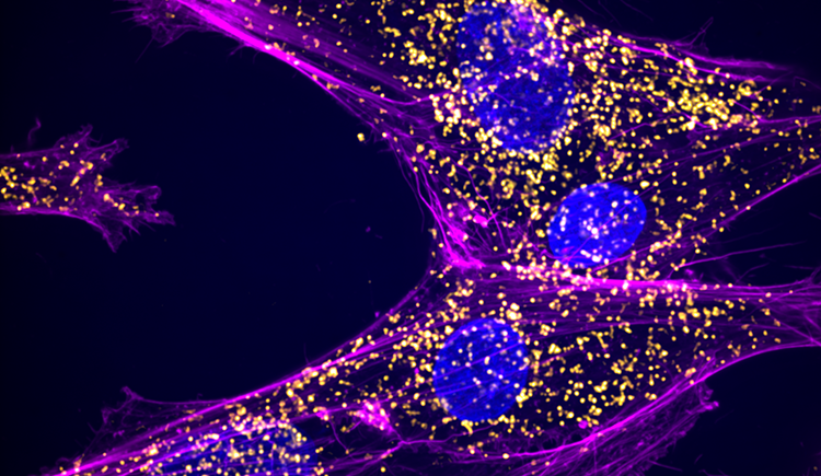 Four cells under a microscope have sweeping lines and round nuclei. Hundreds of tiny yellow dots indicate abnormal RNA molecules.