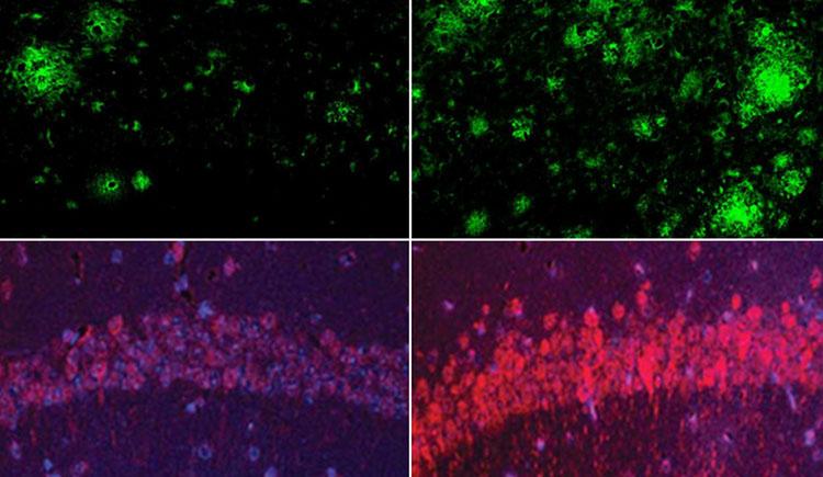 One pair of boxes shows fewer green amyloid clusters on the left and more on the right. Another pair of boxes shows a dim arc of purple and red tau on the left and a brighter arc on the right.