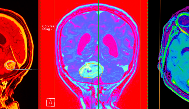 Three vibrantly colored views of a brain MRI showing a large tumor