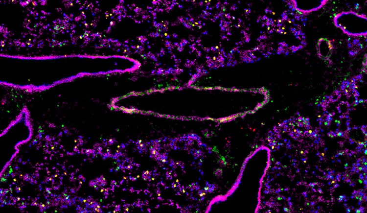 Cross-section of lung tissue shows 6 structures with bright pink outlines and hollow middles, amid purple, green, yellow, and blue dots like a starfield.