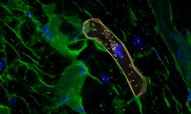Reconstructed microscope view of cardiac cells labeled in blue and green, from a person with hypertrophic cardiomyopathy. One heart cell is outlined in orange and has many dots inside.