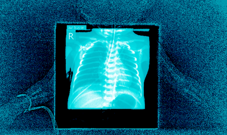 X-ray image of an intubated infant