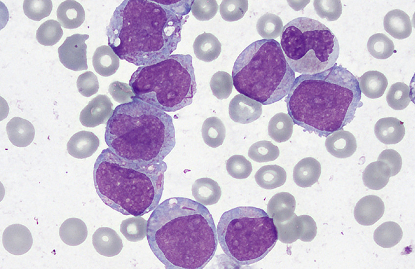 healthy cells shown in gray while cancerous cells are large and stained purple