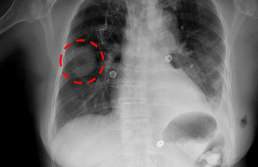 Chest x-ray of a lung mass