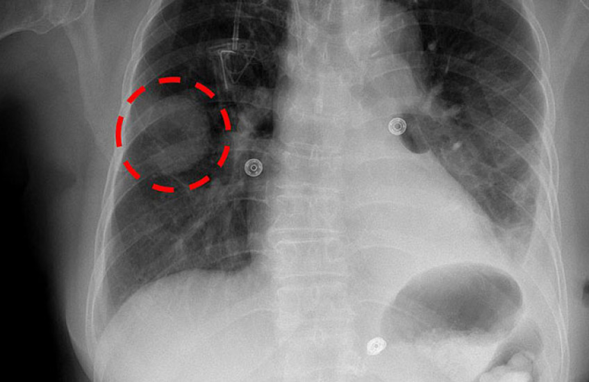Chest x-ray of a lung mass