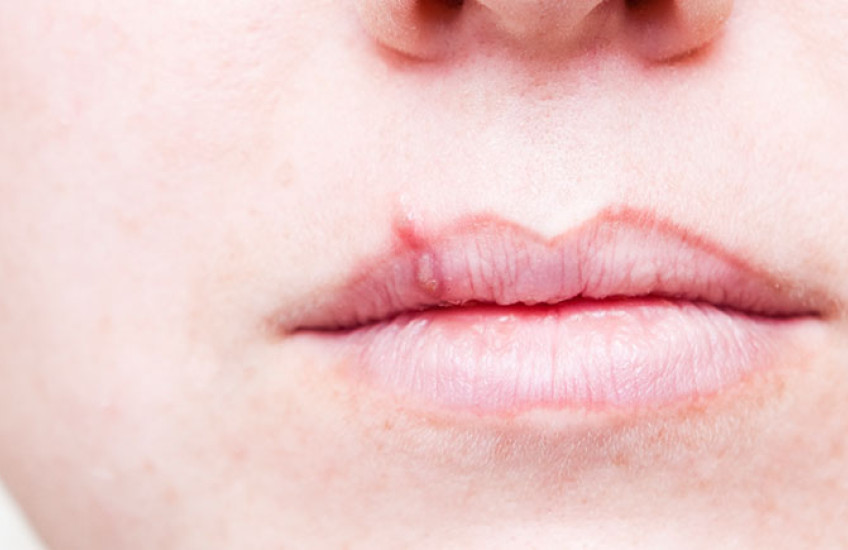 Closeup of a a lip with a cold sore, caused by herpes simplex virus