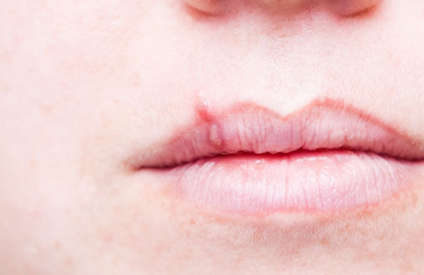 Closeup of a a lip with a cold sore, caused by herpes simplex virus