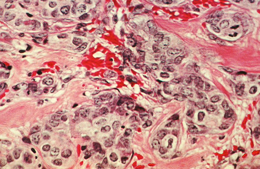 Microscopic image of breast cancer cells with purple, pink, and red shapes