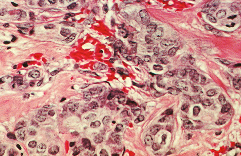 Microscopic image of breast cancer cells with purple, pink, and red shapes.