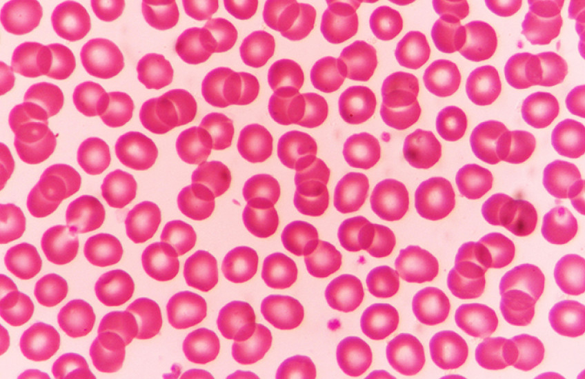 Red blood cells appear as dozens of spheres under a microscope