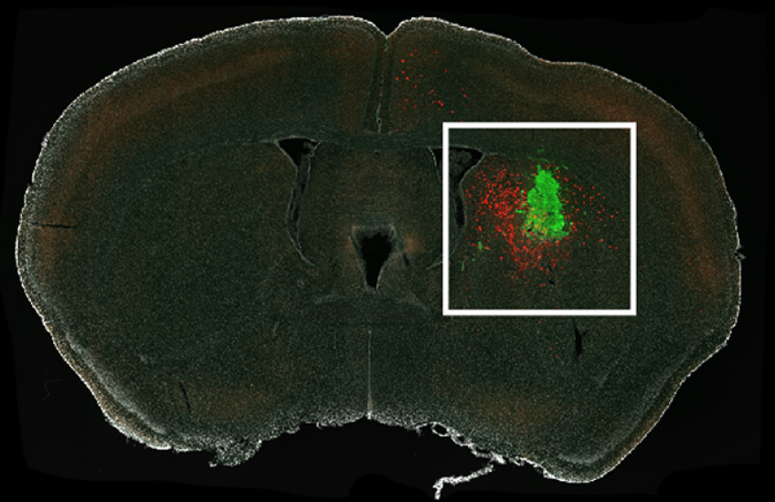 Cross-section of a mouse brain under a microscope shows a cluster of glioma cells tagged in green and connected neurons shown in red, concentrated around the glioma but also stretching from other areas of the brain.