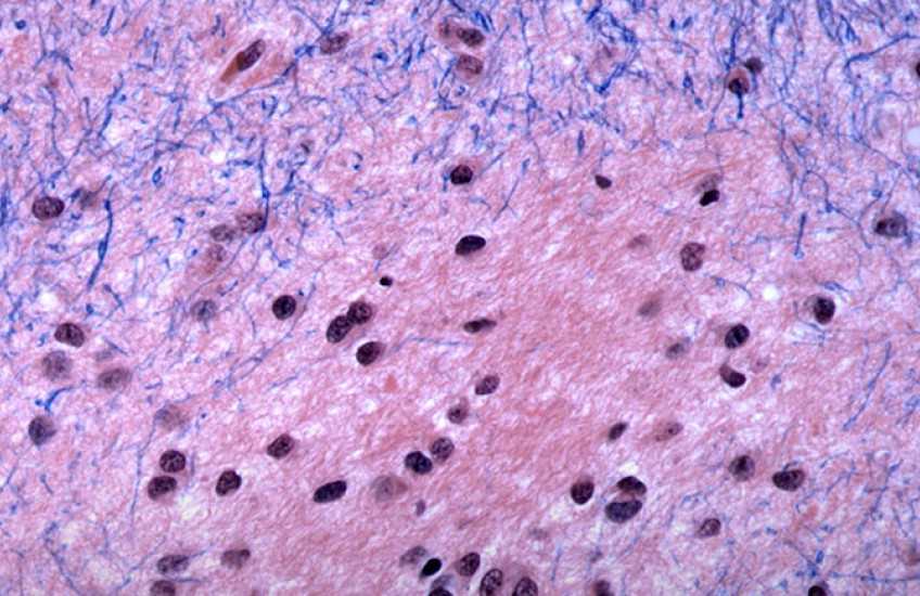 Brain tissue in Huntington’s disease