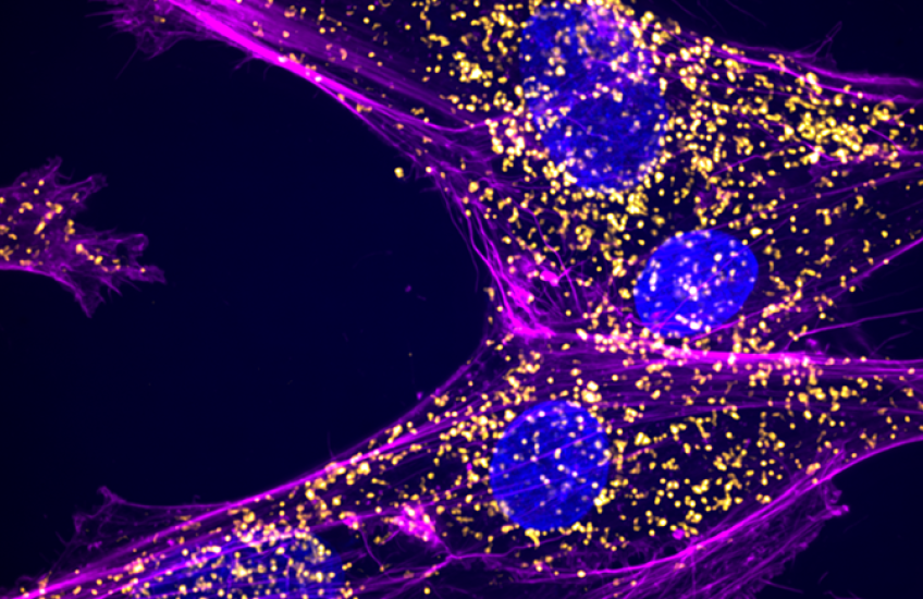 Four cells under a microscope have sweeping lines and round nuclei. Hundreds of tiny yellow dots indicate abnormal RNA molecules.