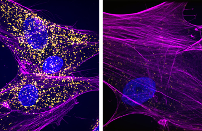 Two side-by-side views of cells under a microscope have sweeping lines and 2-4 round nuclei. The one on the left also contains hundreds of tiny yellow dots, whereas the one on the right has only a few.