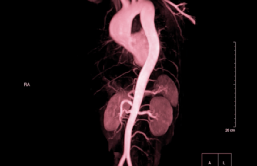 image of a red aorta against a black background