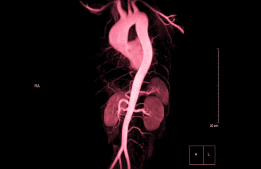 A rotating image of a red aorta against a black background. 
