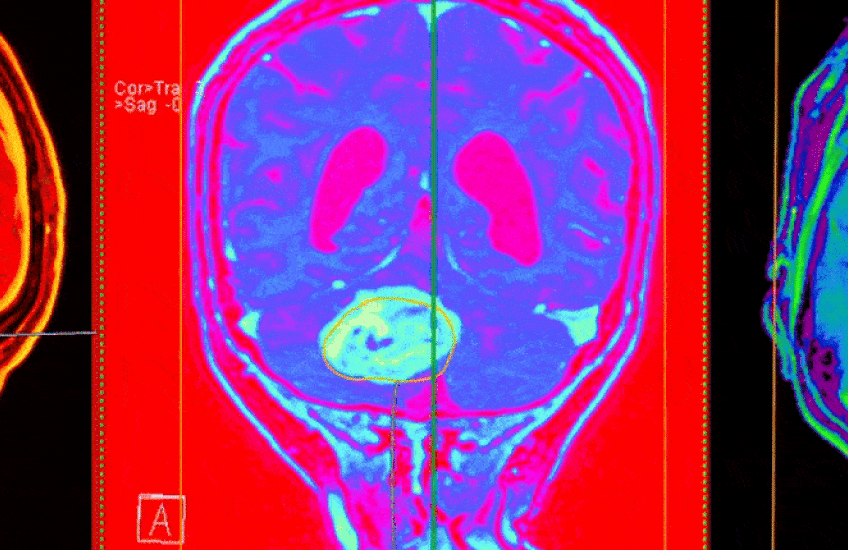 Three vibrantly colored views of a brain MRI showing a large tumor