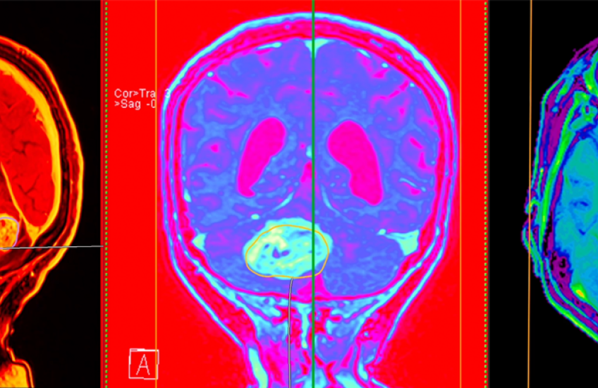 Three vibrantly colored views of a brain MRI showing a large tumor