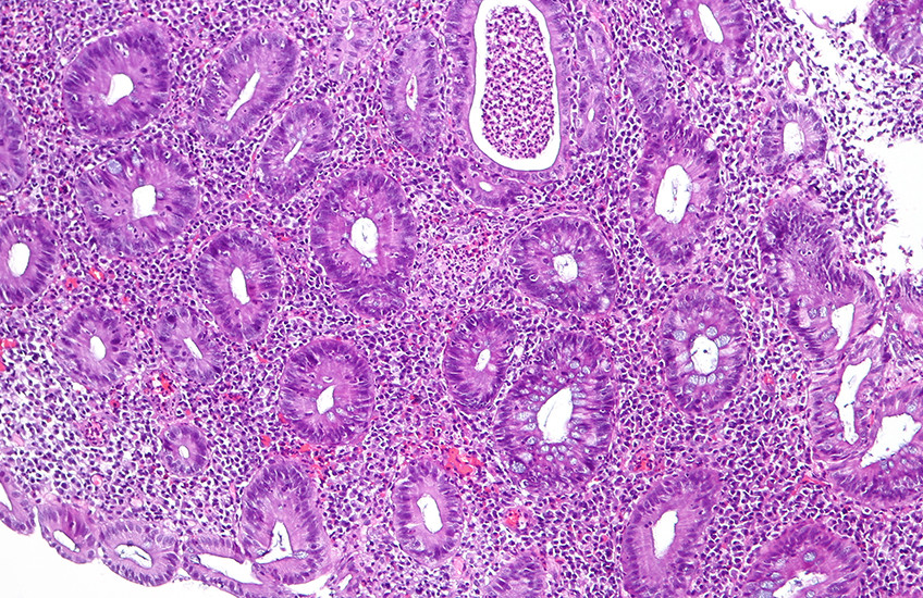 Pink- and purple-stained microscope slide shows normal and diseased features from a patient’s colon.