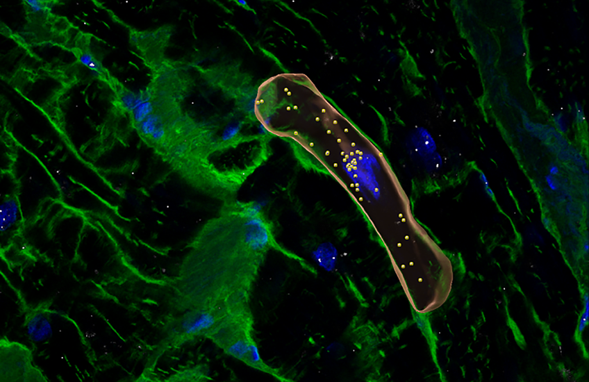 Reconstructed microscope view of cardiac cells labeled in blue and green, from a person with hypertrophic cardiomyopathy. One heart cell is outlined in orange and has many dots inside.
