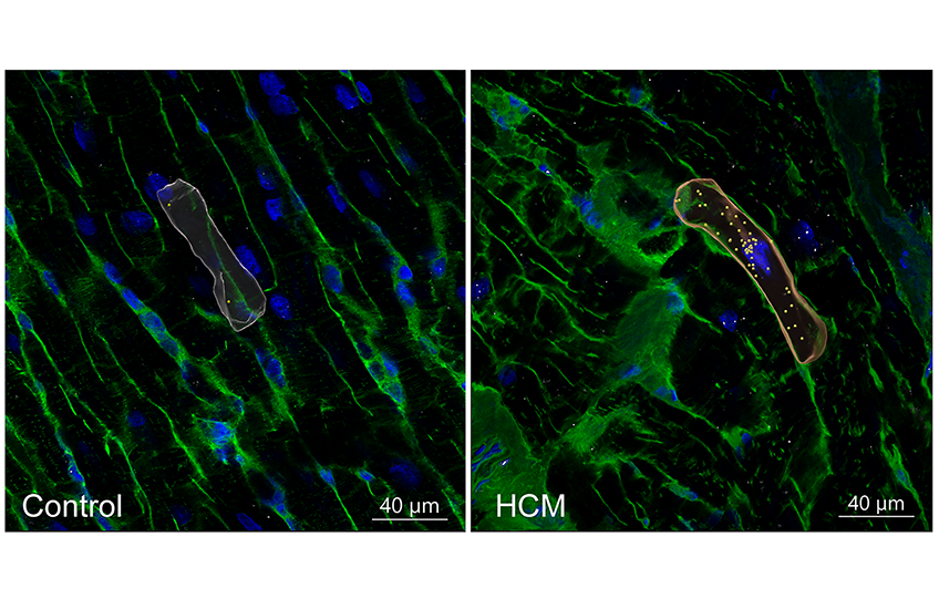 Reconstructed microscope views of cardiac cells labeled in blue and green, one set from a “control” and one from a person with hypertrophic cardiomyopathy. One heart cell in each field of view is outlined in orange. The cell from the “control” has a few dots in it. The one from the HCM patient has many dots.