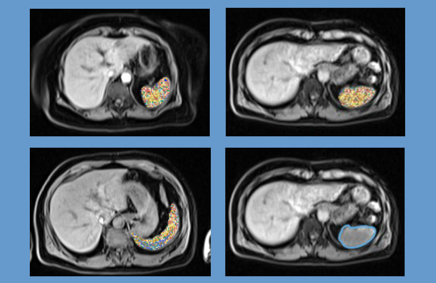 A grid of four abdominal MRI scans, with the spleen outlined in blue or marked by numerous dots added by AI.